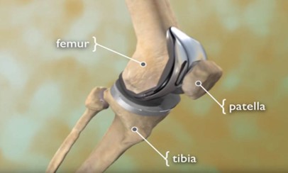 Picture of Total Knee Joint Replacement